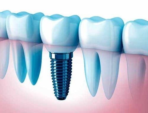 Implantes dentales, estética y funcionalidad