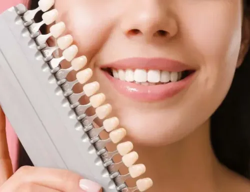 ¿Cuáles son las Principales Ventajas de las Carillas dentales?