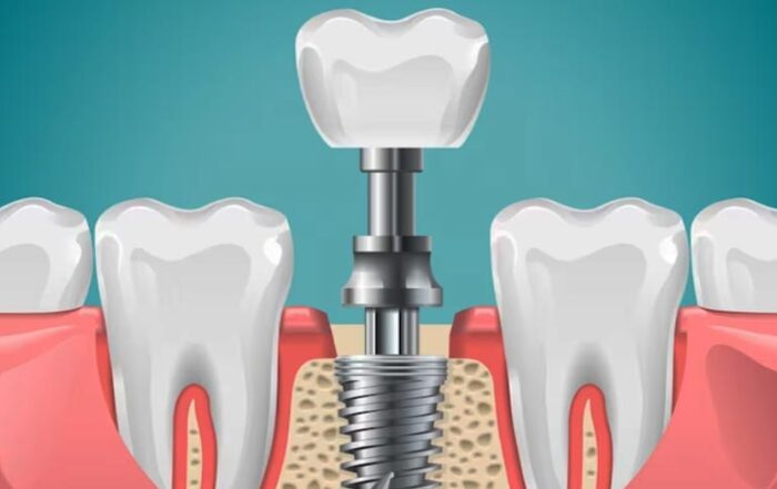 duracion de los implantes dentales