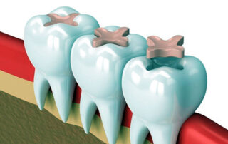selladores dentales