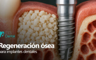 Regeneración ósea implantes dentales