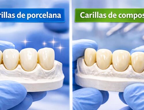Carillas de porcelana vs composite: durabilidad y resultados