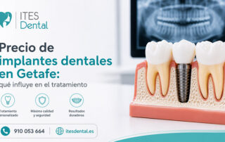 Precio de implantes dentales en Getafe