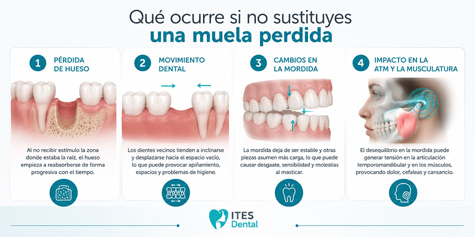 Qué ocurre si no sustituyes una muela perdida